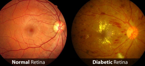 Hero image Diabetic retina